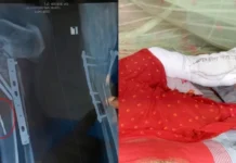 নাটোরের গুরুদাসপুরে মেশিনের ফলা রেখে রোগীর পায়ে সেলাইয়ের ঘটনা তদন্তে কমিটি গঠন